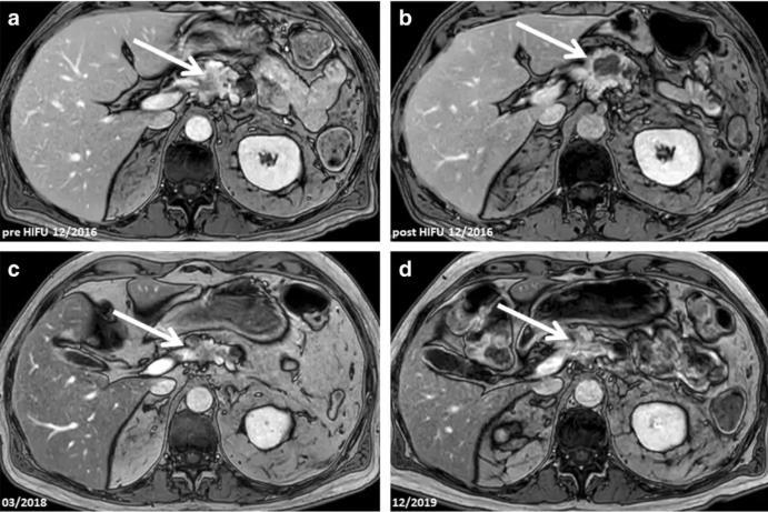 pancreatic cancer