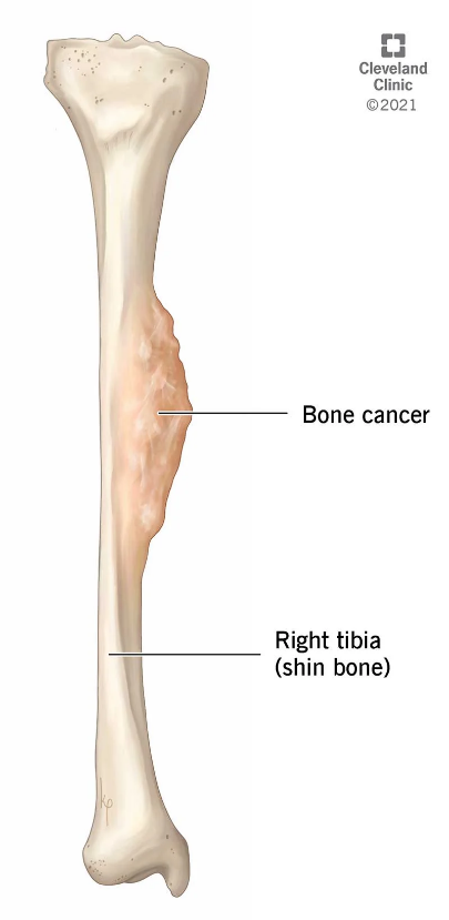 bone cancer