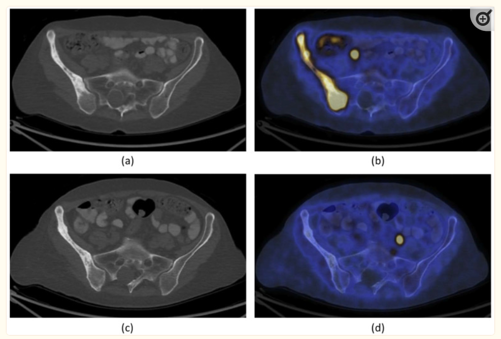 bone tumor